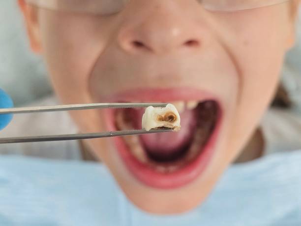 Best Emergency Dental Care for Abscessed Tooth in Glen Ellyn, IL